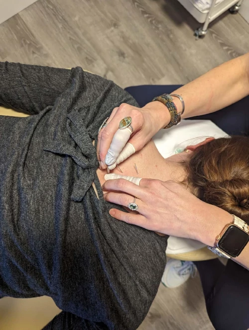Dry needling